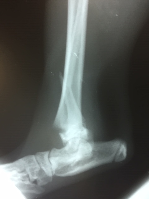 骨折の整復手術　脛骨遠位成長板骨折・腓骨骨折_b0350282_22162590.jpg
