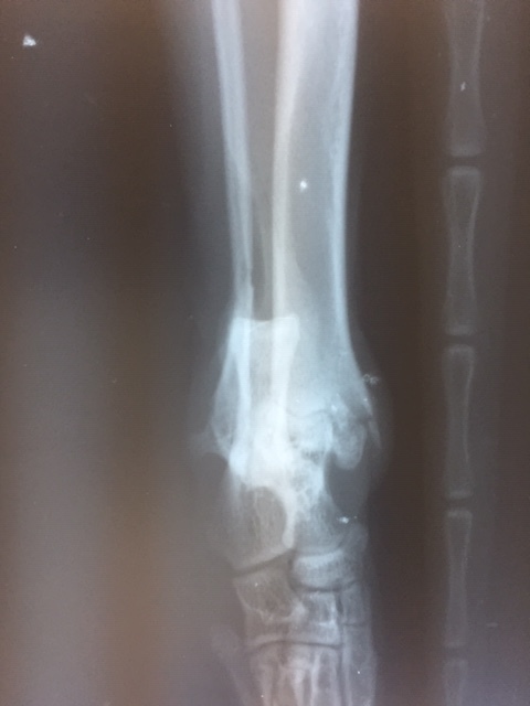 骨折の整復手術　脛骨遠位成長板骨折・腓骨骨折_b0350282_22194911.jpg