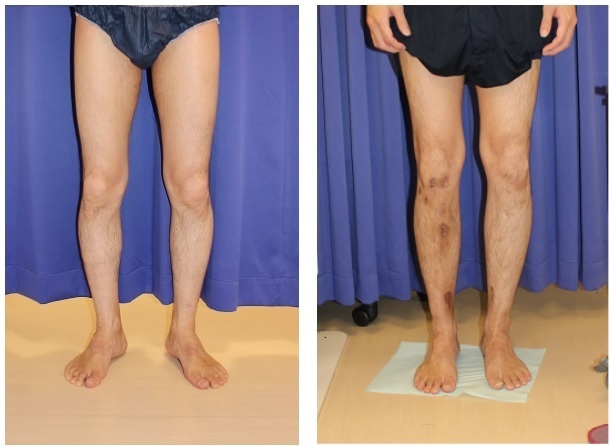 両下腿 5 延長完了 Iskd 右下腿延長終了後 抜釘術後半年後再診 美容外科医のモノローグ