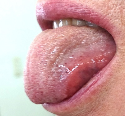 痛い 舌 が 舌が痛い！舌にできた口内炎をすぐに治す５つ方法と舌癌との見分け方