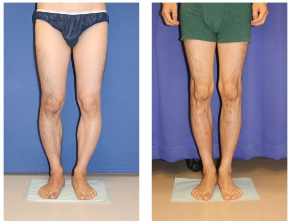 左右下腿　Precice　にて約5㎝延長　初回施術より約2年半_d0092965_01244757.jpg