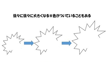 【長年の疑問が解決！？】脳梗塞の前駆症状「閃輝暗点」と下痢した理由「宮入菌欠乏」→俺「やっとわかったヨ！」_a0386130_07201221.png