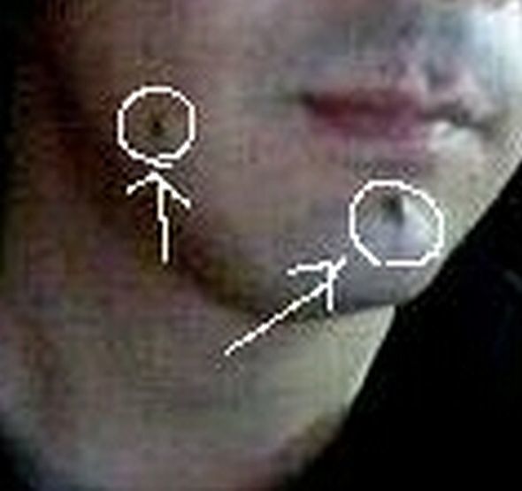 ほくろの除去手術 湘南のjohn Lennon Those Were The Days