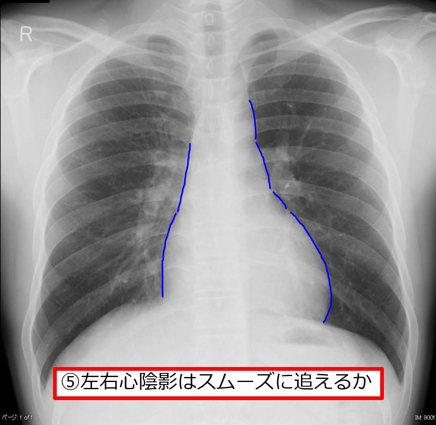 胸写の読み方：2021年5月21日知ってて良かったセミナー : 飯塚病院呼吸 