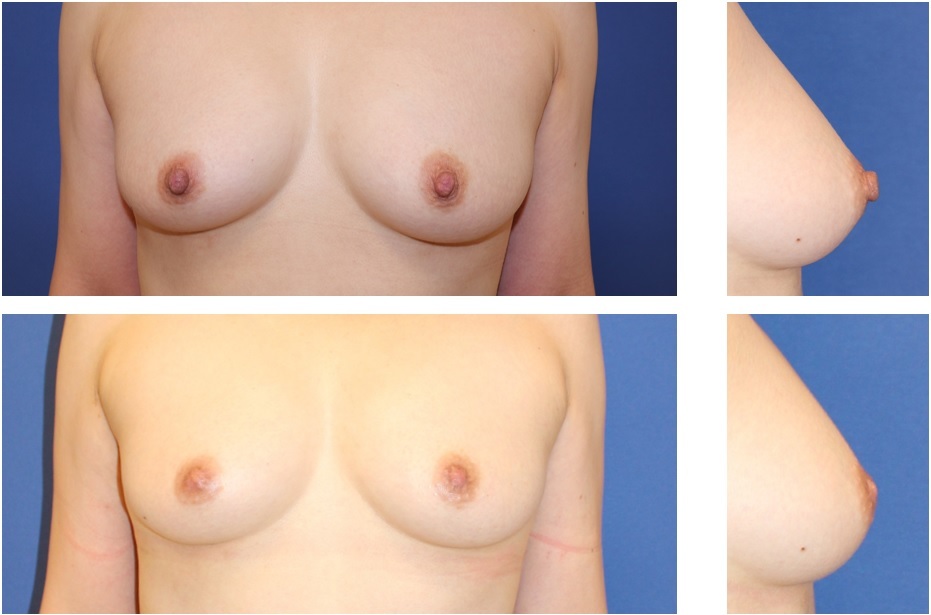 乳頭縮小形成術　術後約3か月　および乳輪乳頭レーザー脱色治療_d0092965_00100280.jpg