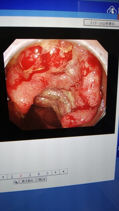 直腸がん　ステージ３（リンパまで転移）_b0124306_18151731.jpg