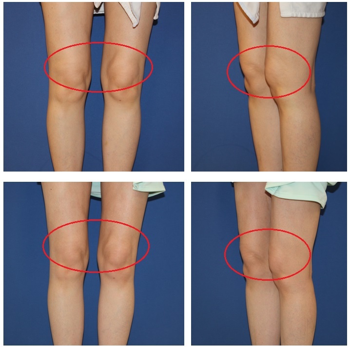 膝上　脂肪　に対する　BNLS　Neo（脂肪溶解注射）　注射　約5か月再診時_d0092965_18365097.jpg