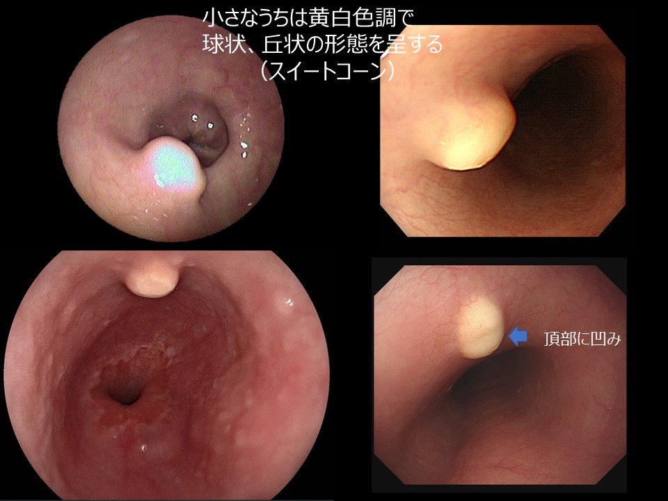 食道顆粒細胞腫 食道癌のブログ