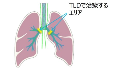 喘息に対する気管支鏡TLDの報告_e0156318_21431629.png