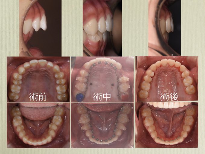 裏側矯正②_a0140882_15280259.jpeg