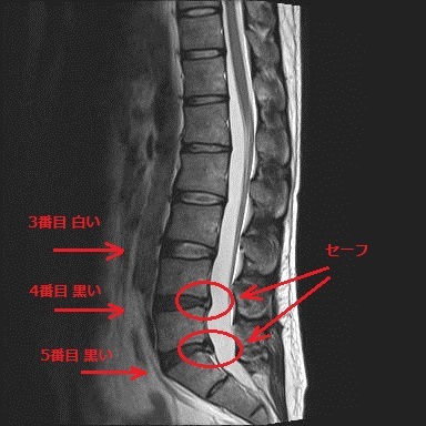 211016腰が痛くてMRI検査に行ったお話(椎間板 変性→椎間板ヘルニア追記)_e0015490_19543238.jpg
