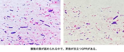 便の塗抹が威力を発揮する唯一無二(と思う)の疾患_d0402367_12584869.jpg