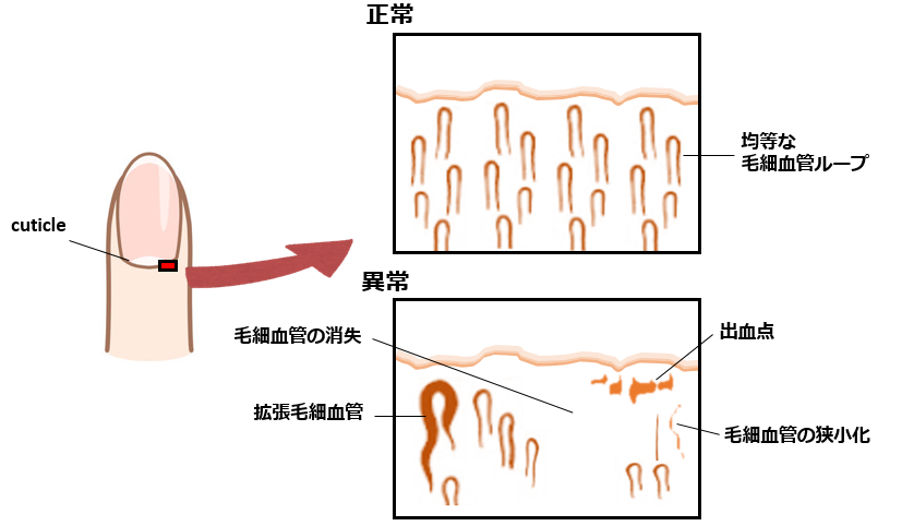 間質性肺疾患患者における爪床毛細血管異常は膠原病の予測因子_e0156318_21012367.png