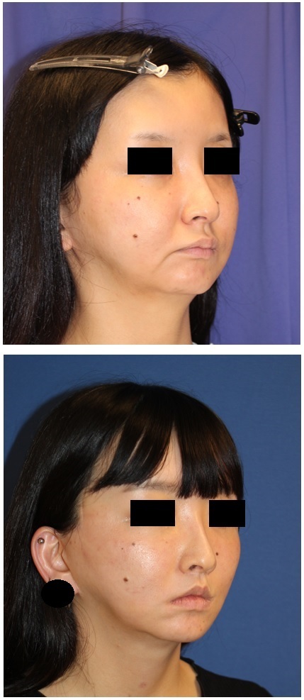 ベイザー併用脂肪吸引（法令口角、頬、顎下）、SMASフェイスリフト、ネックリフト　術後２年再診時_d0092965_02343945.jpg