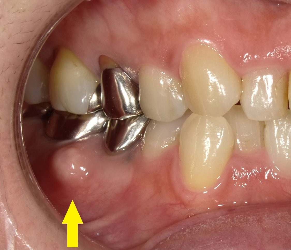 予防歯科の第3の敵、　歯の破折　Part3_b0119466_00273364.jpg