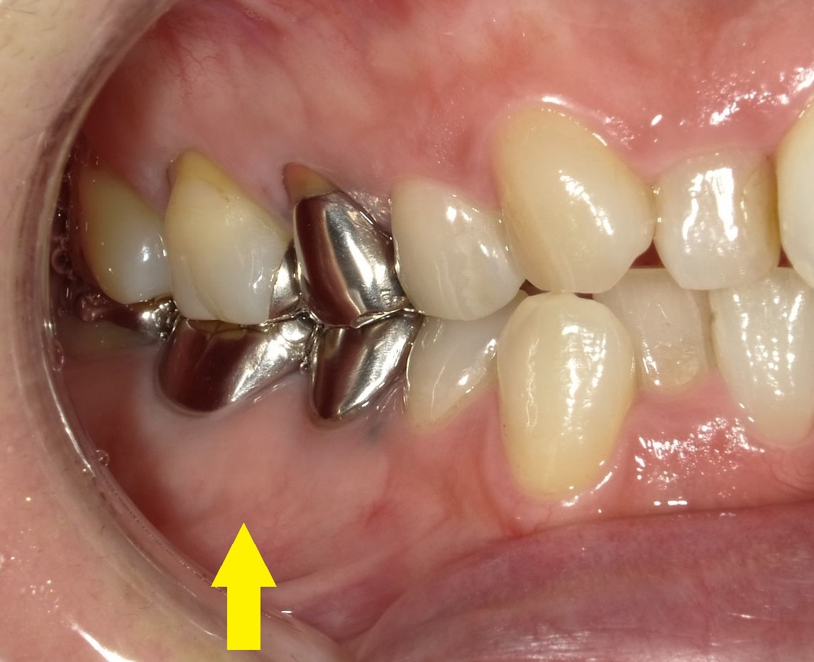 予防歯科の第3の敵、　歯の破折　Part3_b0119466_00295491.jpg