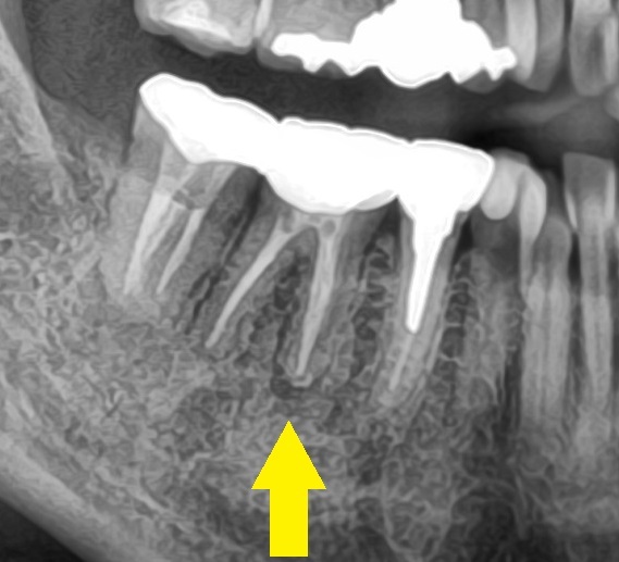 予防歯科の第3の敵、　歯の破折　Part3_b0119466_00495635.jpg