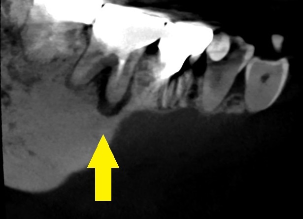 予防歯科の第3の敵、　歯の破折　Part3_b0119466_00564212.jpg
