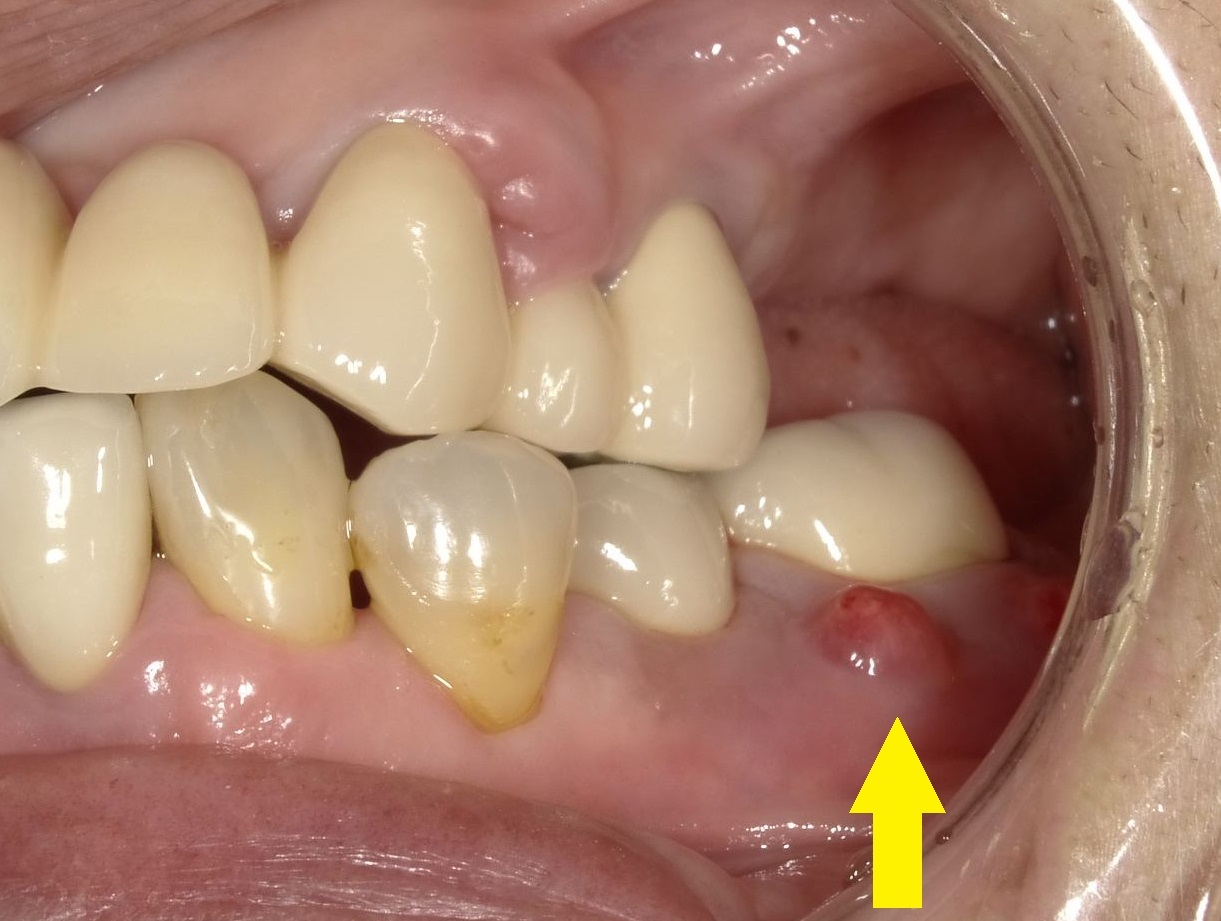 予防歯科の第3の敵、　歯の破折　Part5　抜かないという選択_b0119466_22481073.jpg
