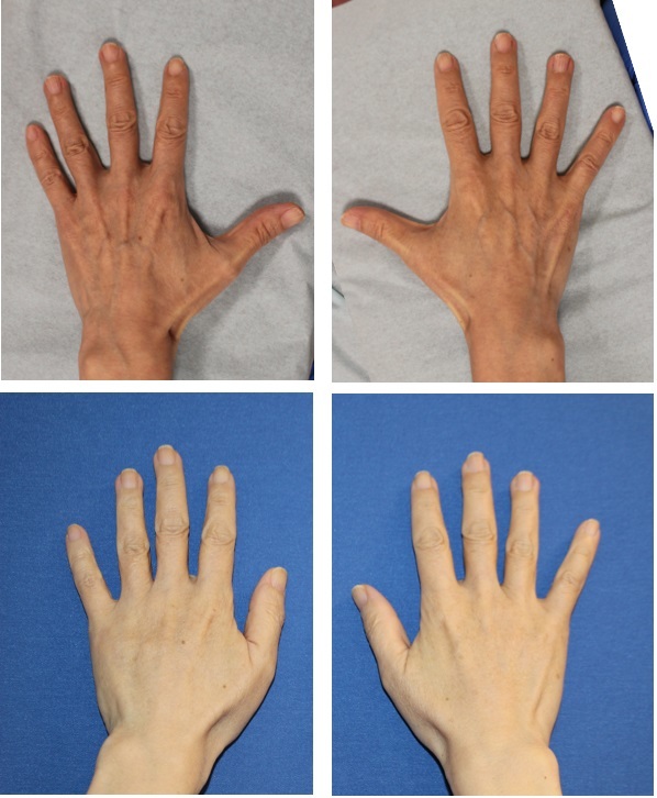 手の甲の若返り　　：　　手の甲への脂肪移植＋幹細胞増殖因子_d0092965_22413623.jpg