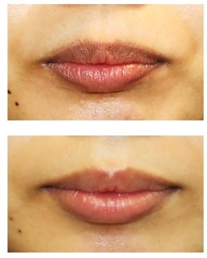 口唇脱色治療　治療開始約半年後再診時_d0092965_01101663.jpg