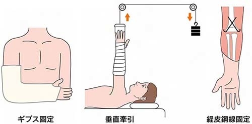 小児骨折治療