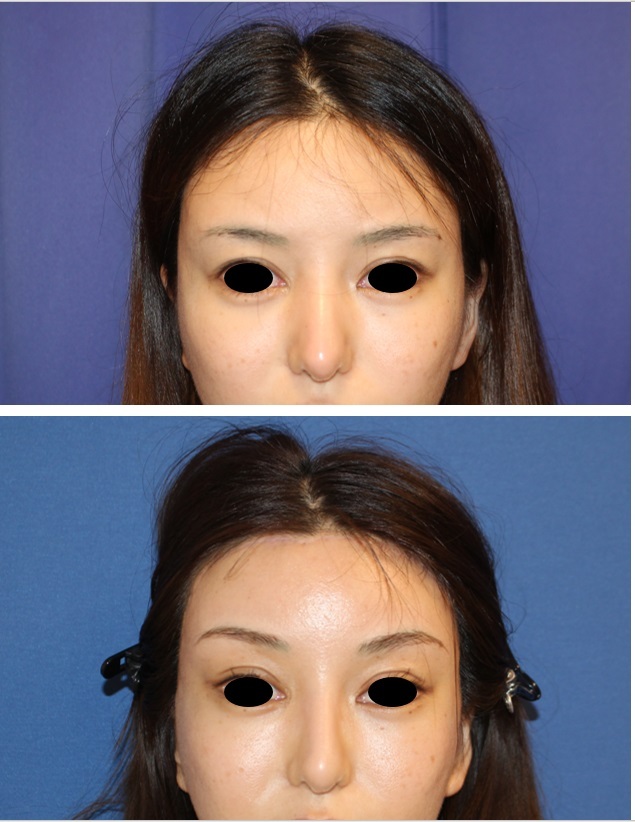 エンドタイン(endotine forehead)使用　額リフト、　こめかみリフト　鼻根縮小術　術後約3か月再診時_d0092965_00371793.jpg