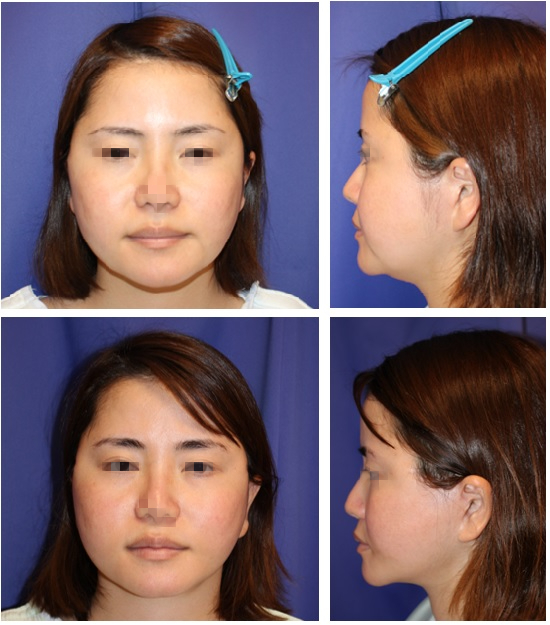 SMASリフト　顎下　および　マリオネットライン　脂肪吸引　術後約1年再診時_d0092965_01210178.jpg