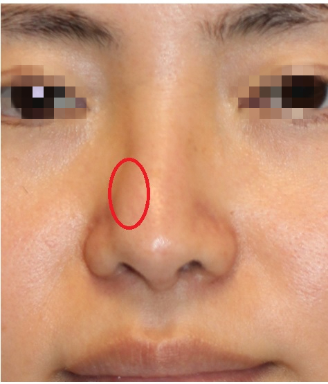 鼻のふくらみに対するレーザー治療　+　鼻孔縁下降術_d0092965_02572586.jpg