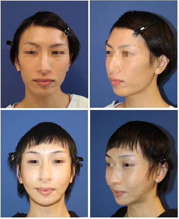 頬骨再構築法（勝間田医師：術後約1年3か月）、頬骨前方削り+下顎骨Vライン形成術（伊藤医師：術後約半年）_d0092965_12165609.jpg
