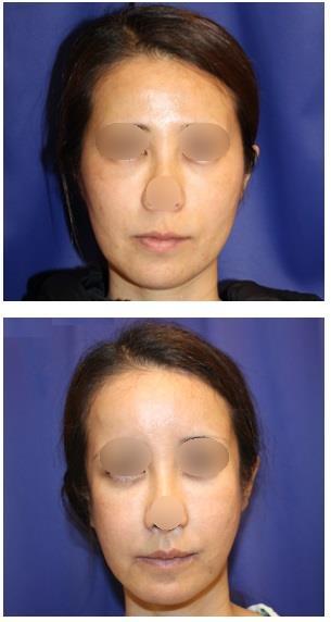 頬骨再構築法：cheekbone reconstruction surgery.術後　約半年再診時_d0092965_06481034.jpg