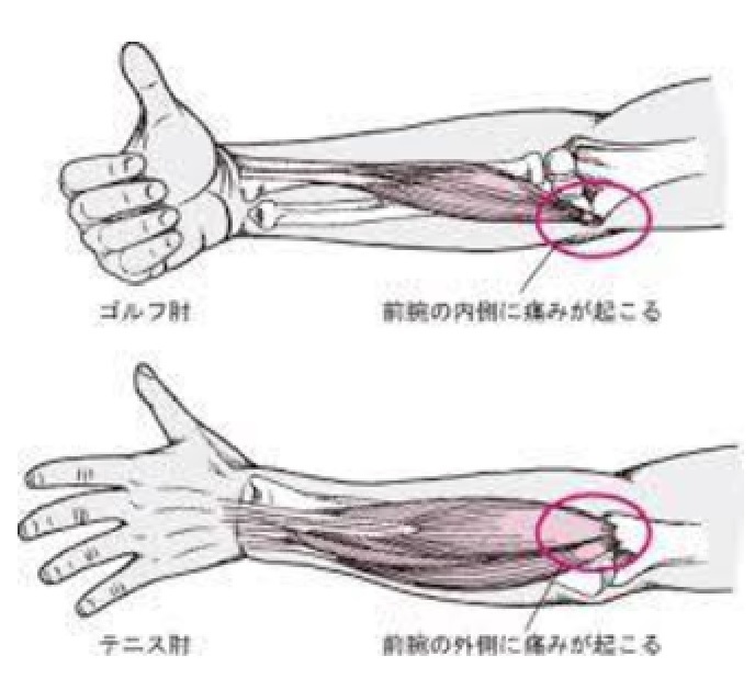 右肘が「ゴルフ肘」になったような感じで痛い_d0103292_20485518.jpg